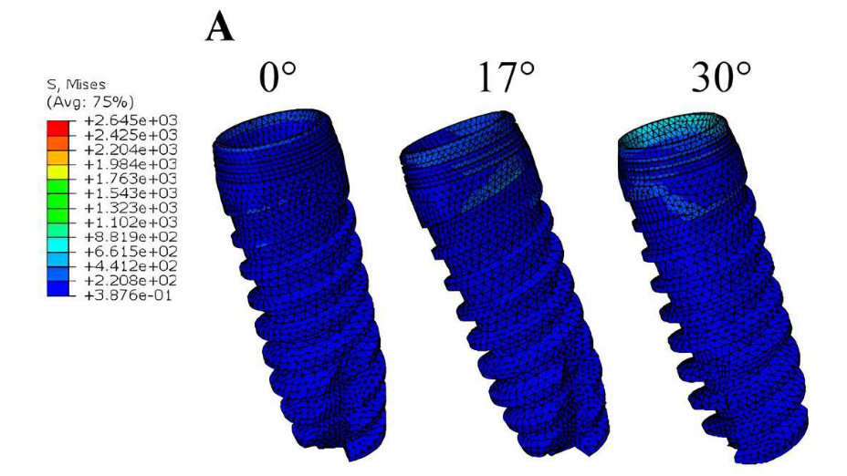 The stress distribution of the implant of the MUA-implant complex with different abutment angulation (0°, 17° and 30°). A, The stress distribution of implants under loading condition A, B. The stress distribution of implants under loading condition B.C, The stress distribution of implants under loading condition C. Research Square/ rs-4446322/v1/ Dong Lin/ Jun 2024