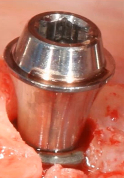 Subcrestal implant placement with multi-unit abutment and double platform switching.