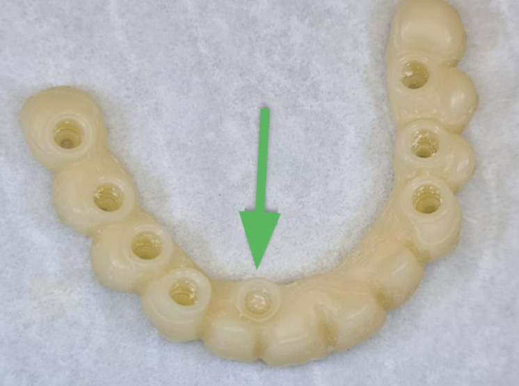 New temporary bridge without screw channel in the area of ​​the second incisor