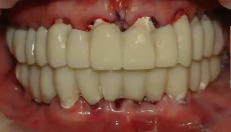 Temporary denture prosthesis on upper and lower arches immediately after placement showing white teeth