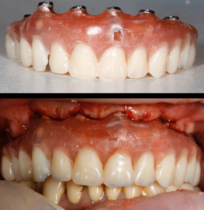 Temporary full arch dental prosthesis with metal implant attachments and thick pink acrylic base