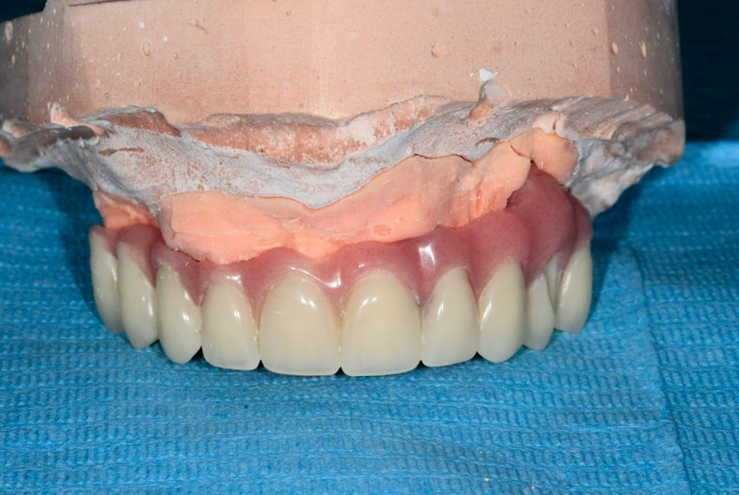 Frontal view of the temporary acrylic prosthesis with stock teeth, supported by three implants.