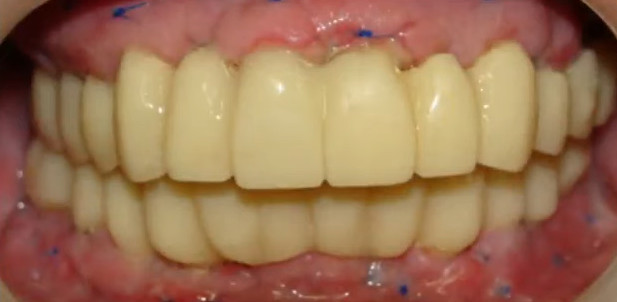 Temporary full arch restoration on upper and lower dental implants immediately after placement