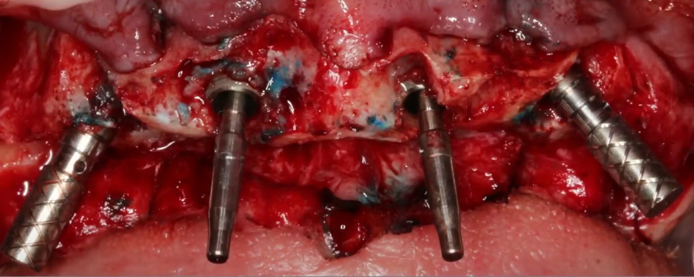 Four dental implants shown after placement in the upper jawbone, with distal implants tilted to avoid anatomical limitations.