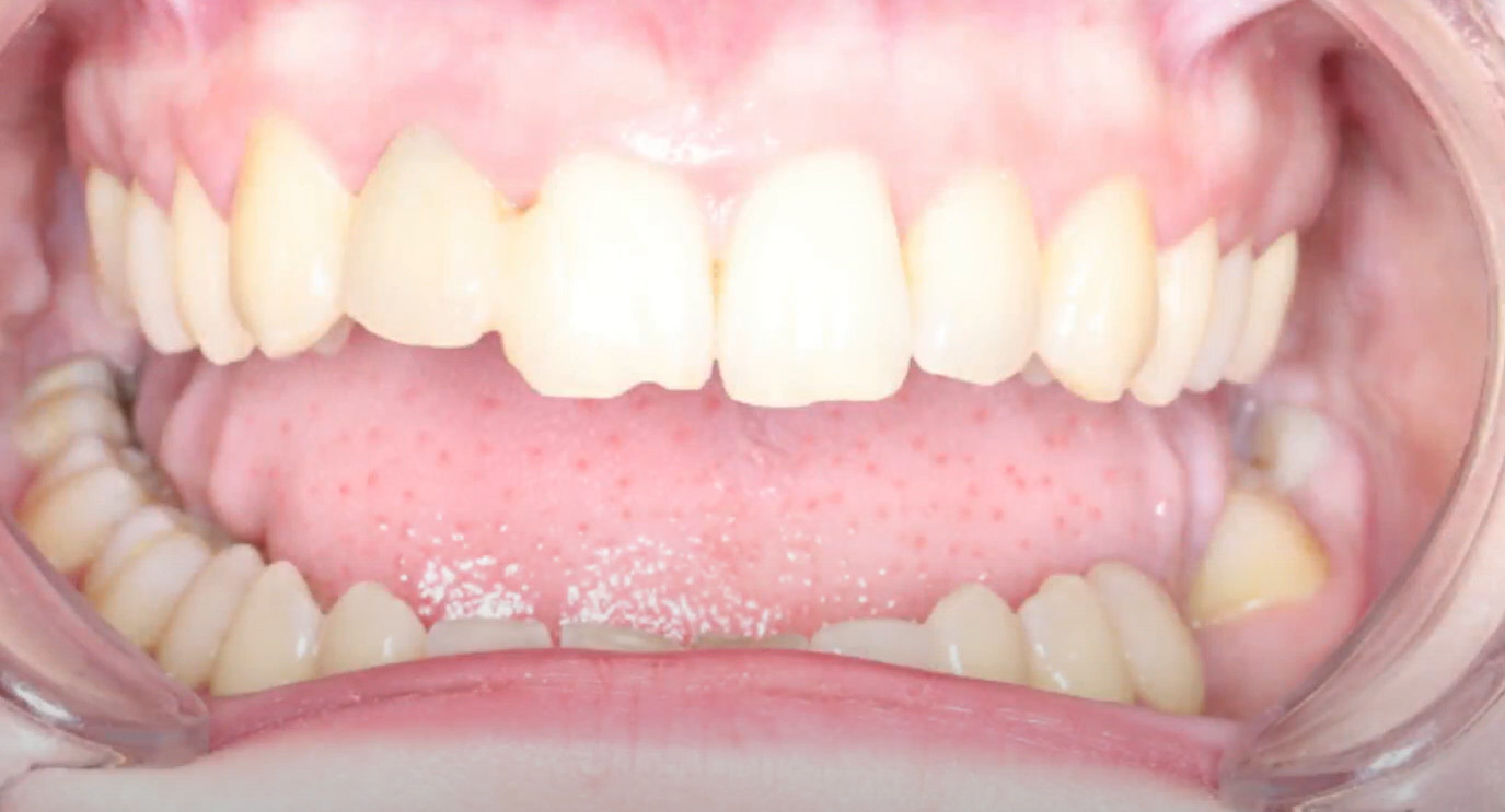A temporary prosthesis is made from the coronal part of an extracted tooth