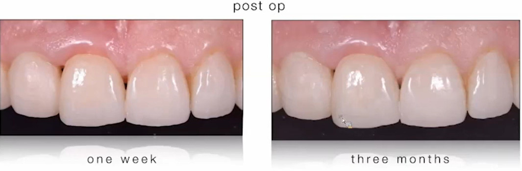Sequential comparison showing gingival and papilla development around the crown over the healing period.