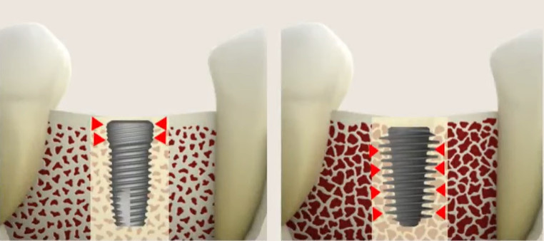 The difference in fixation principles between cortical (left) and cancellous (right) implants