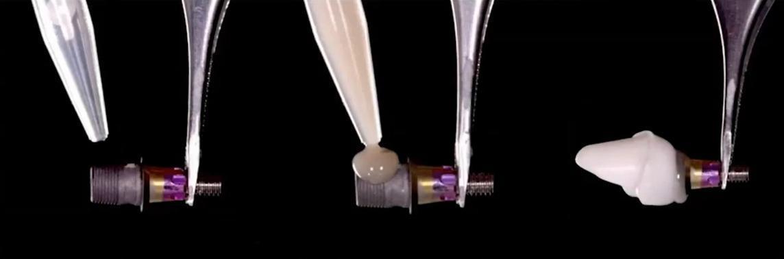 Laboratory step showing cementation of the custom abutment onto a Ti-base.