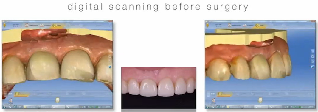 Screen view of the digital scan workflow used to capture and preserve the crown shape for future restoration.