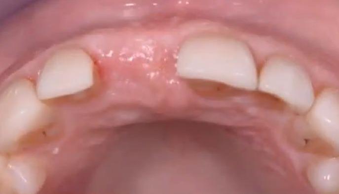 Healing soft tissue one week after extraction with the socket area nearly closed.