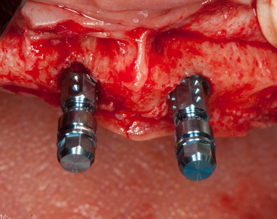 Two tissue level dental implants placed in exposed jawbone during surgical procedure