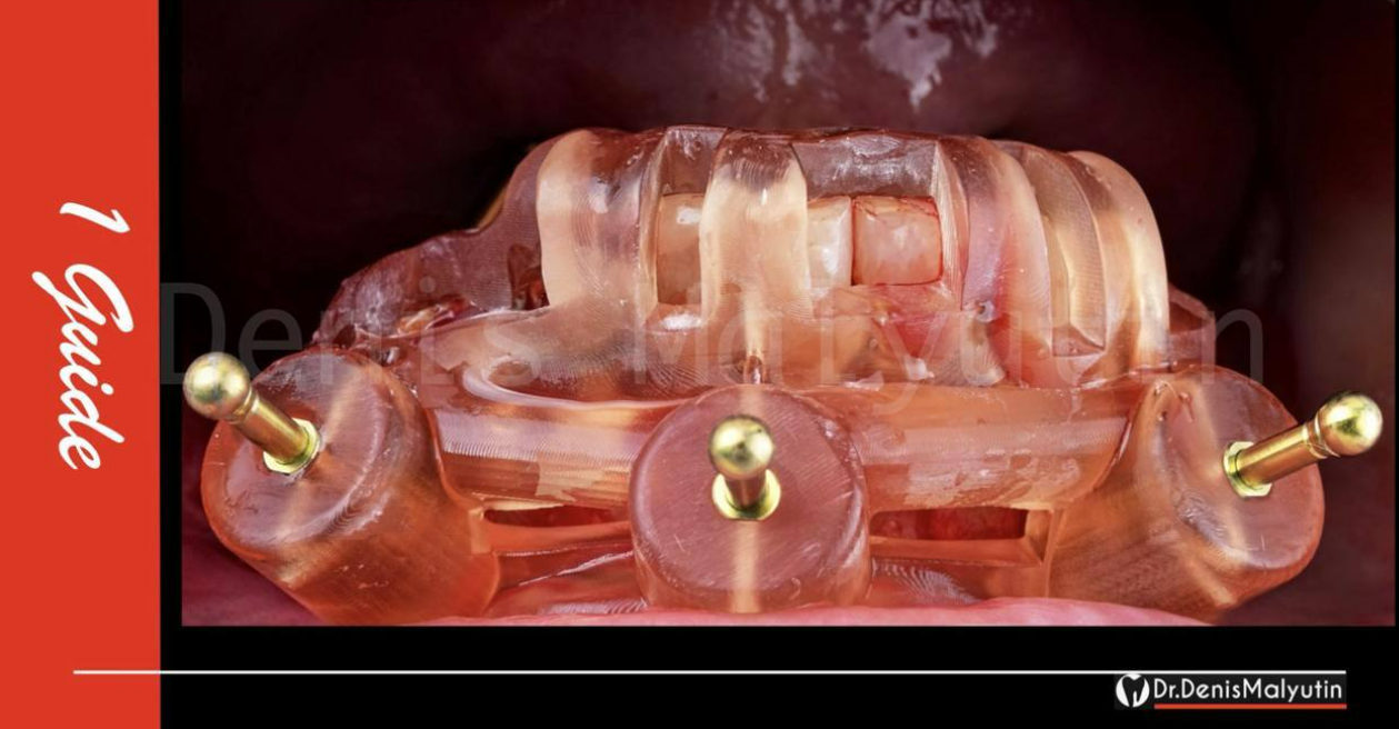 Transparent acrylic denture base showing internal structure with three gold ball abutments