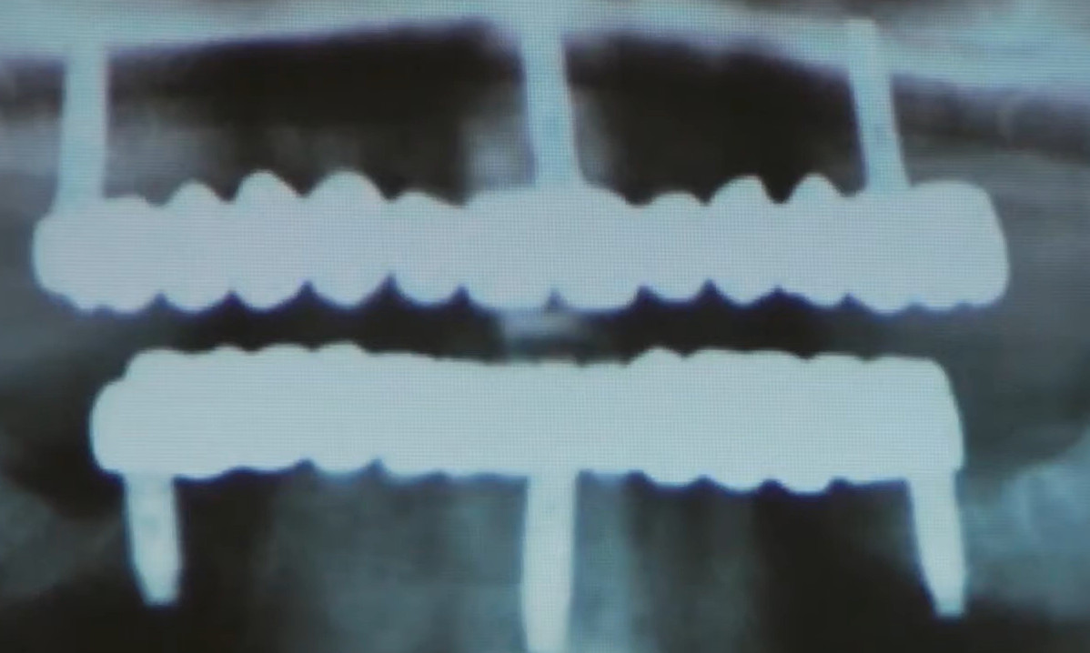 Dental implants positioned in optimal triangular pattern with minimal cantilevers