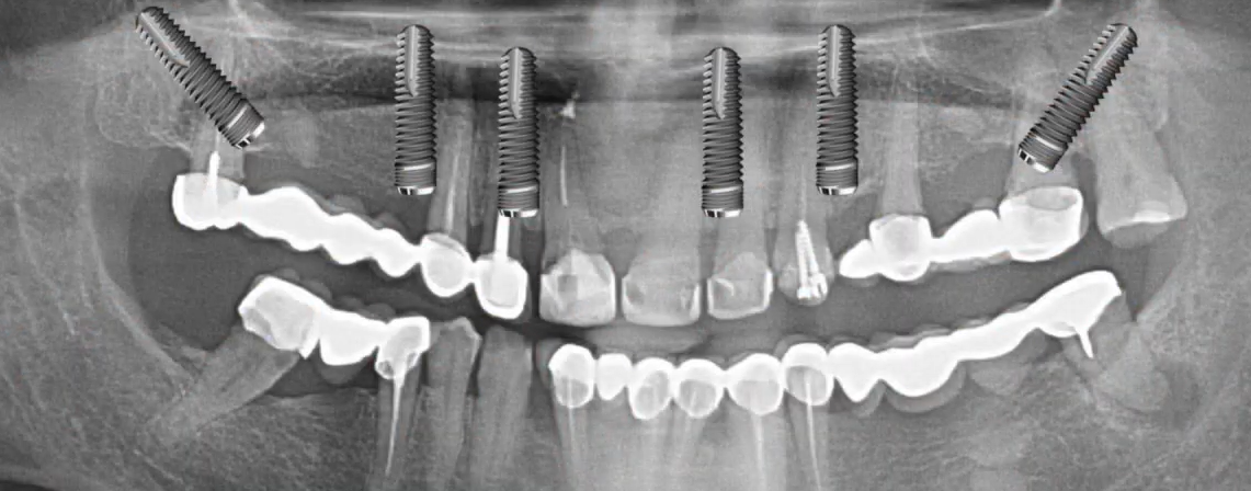 Panoramic view of six maxillary implants with distal tuberosity anchorage.