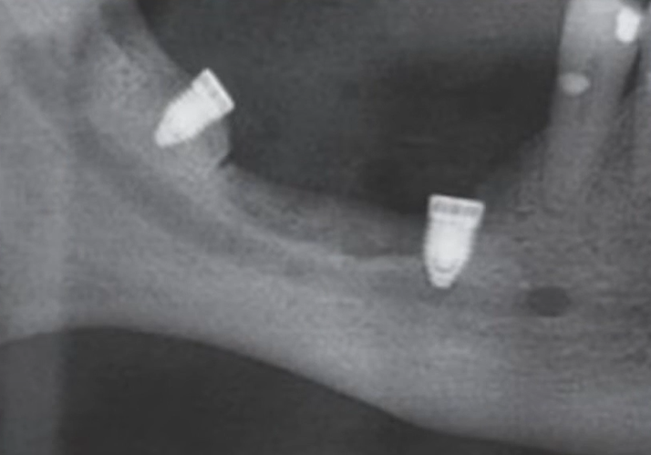 X-ray showing two short dental implants surgically placed in remaining jawbone