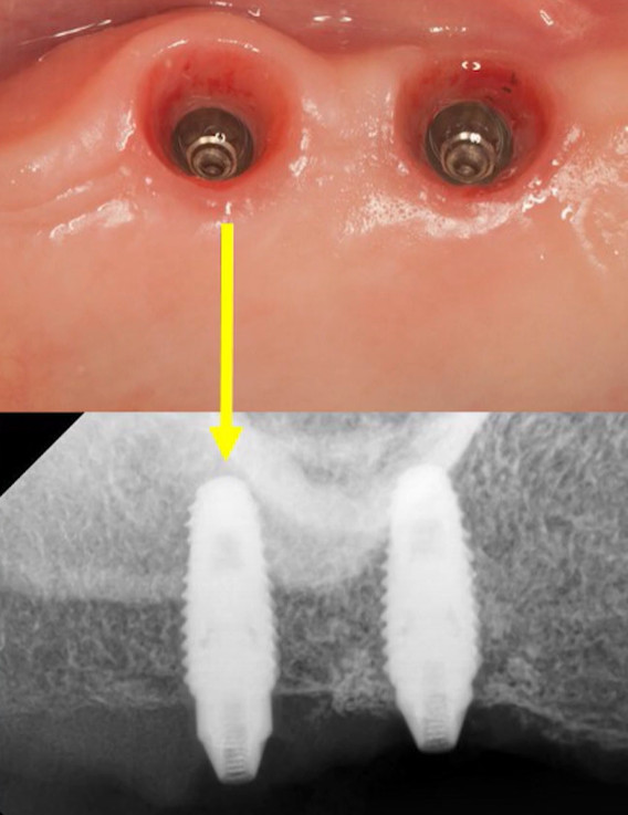 Failed dental implant spinning during multi-unit abutment placement at site 17