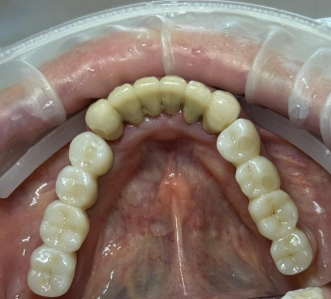 Final zirconium dioxide screw-retained bridge installed on six XGATE implants.