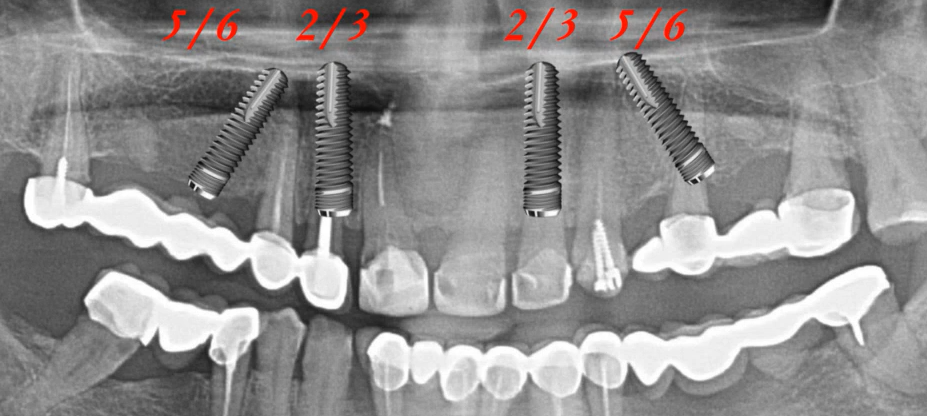 Panoramic x-ray showing four angled dental implants in upper jaw with position markers 5/6, 2/3 indicating optimal placement locations