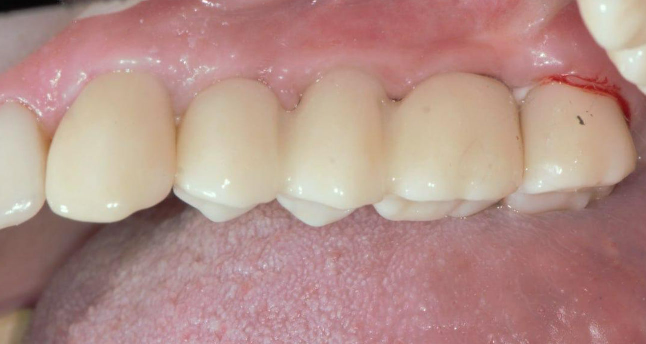 Close-up view of upper front teeth with natural-looking dental crowns and healthy pink gum tissue