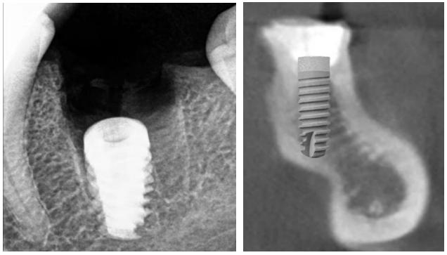 Dental radiographs showing two vertical implant positioning errors: left image shows implant placed too deep below crestal bone, right image shows overly long implant penetrating through jaw