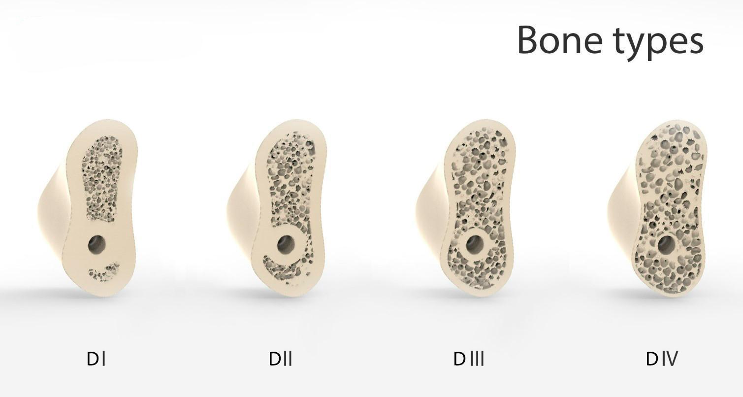 Visualization of the four main bone types, D1-D4
