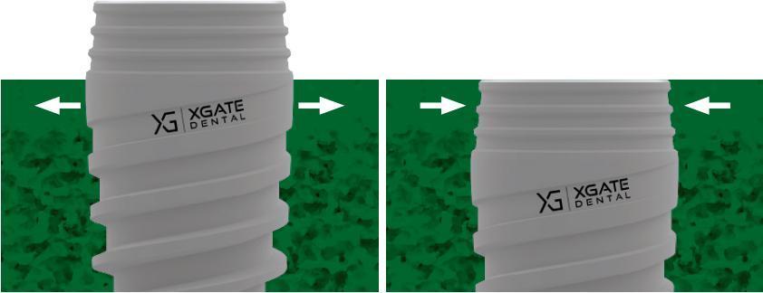 Visualization of the reverse taper concept: the cortical bone gently grips the