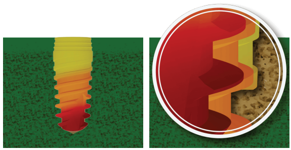 XGate dental implant showing variable thread profile with gradient color transition from yellow to red