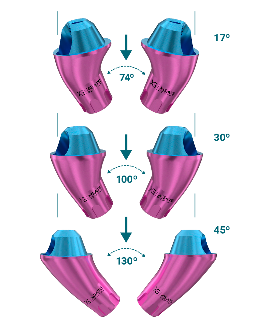 Comparison of XGATE angulated implant solutions showing V-Type and D-Type options