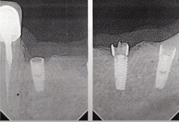 Unsuccessful fit of the restoration with internal stress leading to implant failure 2