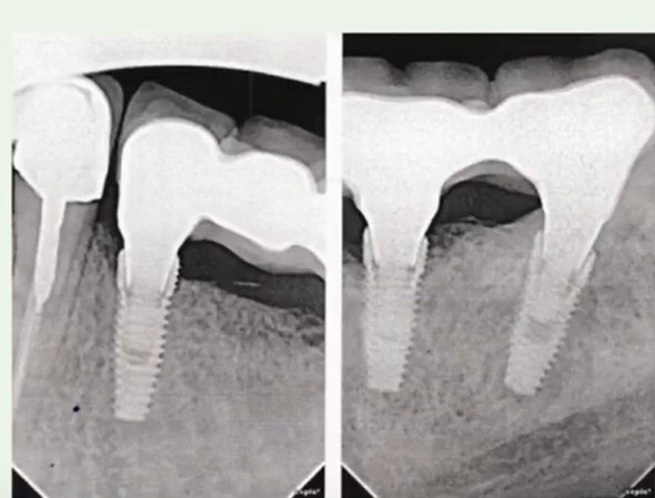 Unsuccessful fit of the restoration with internal stress leading to implant failure 3