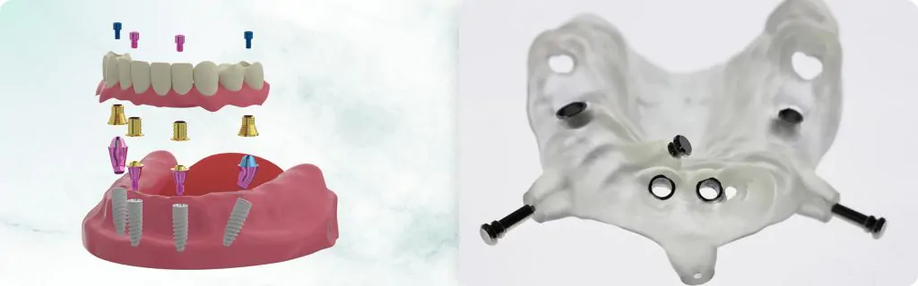 Full-arch: Angled Abutments and Tilted Implants – How to Mitigate Risks and Maximize the Benefits of Full-arch-on-4/6 implants. Part 1