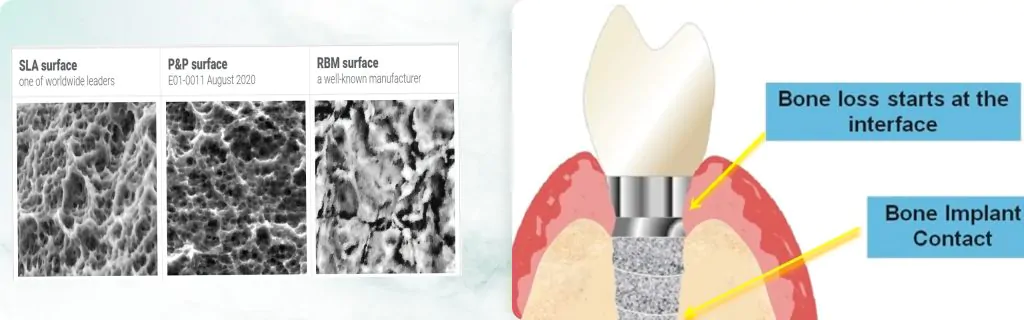 A Review of Dental Implant Surface Coatings and Their Impact on Healing Rates
