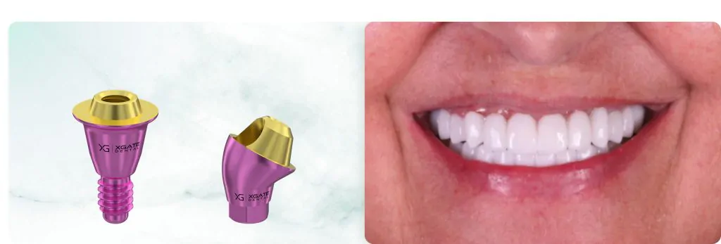 Complete Maxillary Rehabilitation on 8 Implants Using a Combination of XGATE Dental D-Type and V-Type Multi-Unit Abutments