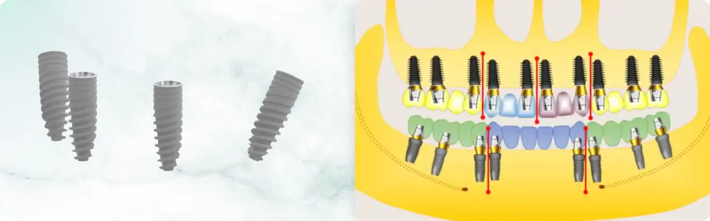 Thread, Taper, and Reverse Taper: How Implant Shape Determines Its Application. Part 2