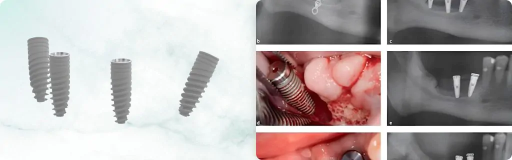 Short Implants: Who, Why, and When (Implant Length). XGATE Dental