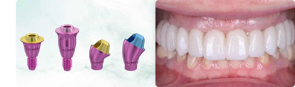 Total Maxillary Rehabilitation: Fixation of a Zirconia Prosthesis on V-Type and D-Type Multi-Unit Abutments