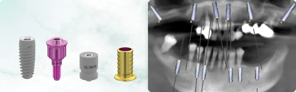 Full-Arch Rehabilitation of the Maxilla and the Mandible Using a Digital Protocol and Superstructures by XGATE Dental