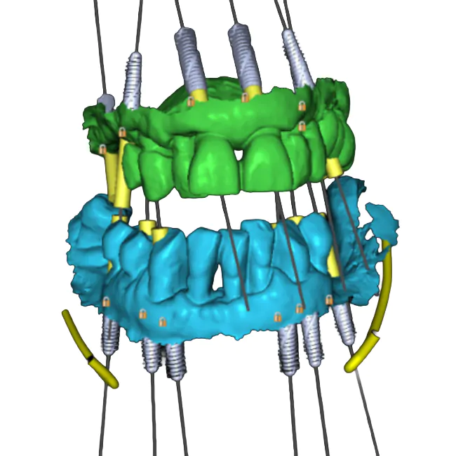 Full-Arch Rehabilitation of the Maxilla and the Mandible Using a Digital Protocol and Superstructures by XGATE Dental