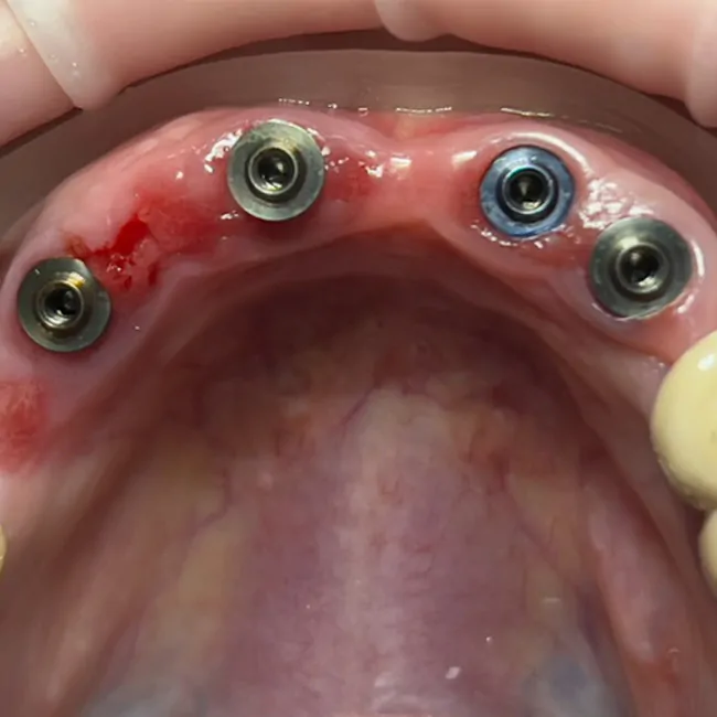Full-Arch Restoration of Maxillary and Mandibular Arches with Mandibular Tooth Extraction: Screw-Retention on V-type and D-type Multi-Unit Abutments by XGate Dental