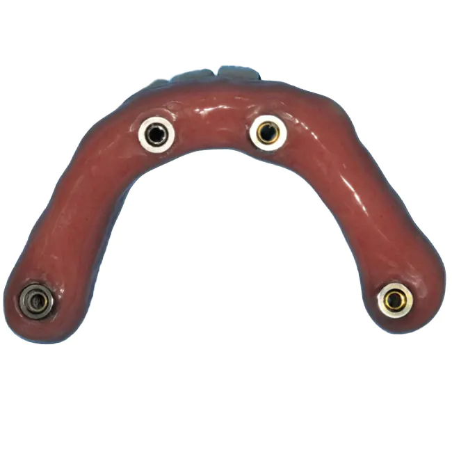 Mandibular Rehabilitation with a Bar-Supported Prosthesis on 4 Implants Using XGATE Products