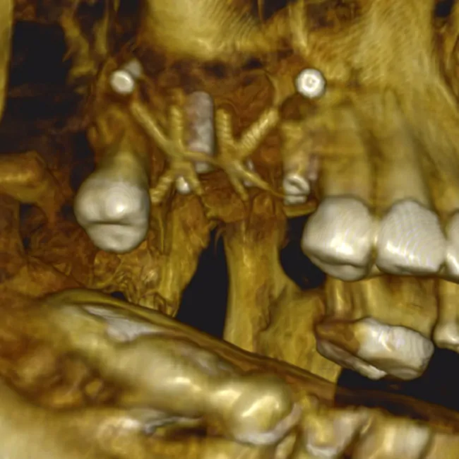 Simultaneous Placement of XGate Dental Implants with Guided Bone Regeneration