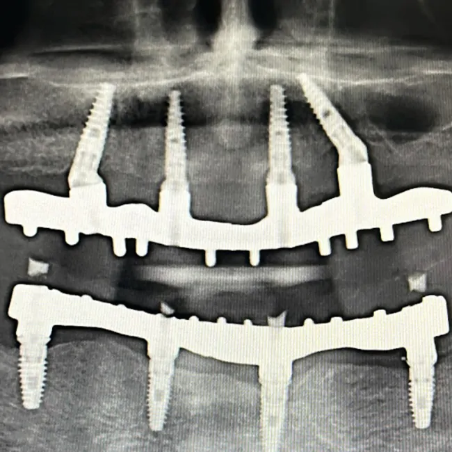 Total Rehabilitation of the Maxilla: a Screw-Retained Prosthesis Using Implants and MUAs by the German Brand XGATE