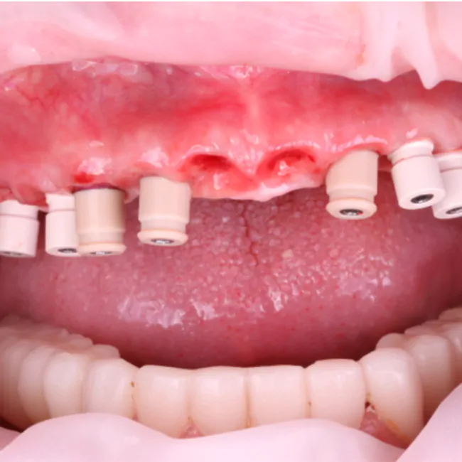 Complete Maxillary Rehabilitation on 8 Implants Using a Combination of XGATE Dental D-Type and V-Type Multi-Unit Abutments