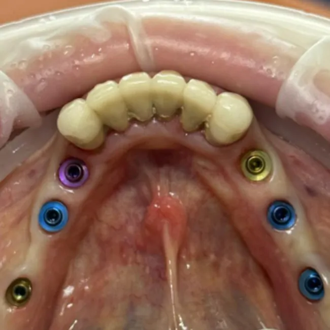Replacement of a Removable Denture with a Permanent Implant-Supported Restoration: Screw Retention on MUA V-Type XGATE Dental